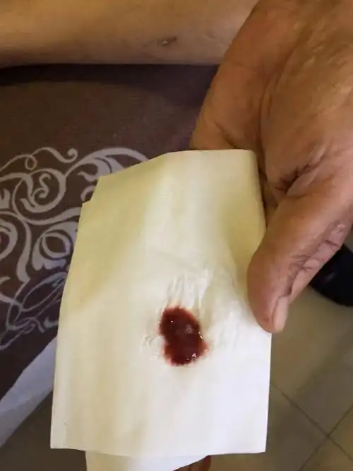 化疗联合免疫治疗之后咳血-肺癌康复圈-觅健