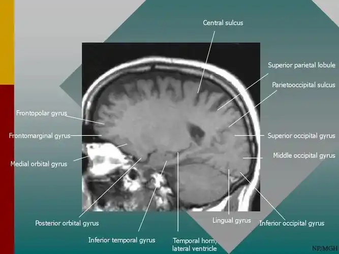 正常神经系统解剖(mri)ppt