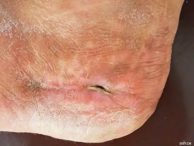 跟骨粉碎性骨折术后8个月伤口不愈合!寻求对策1