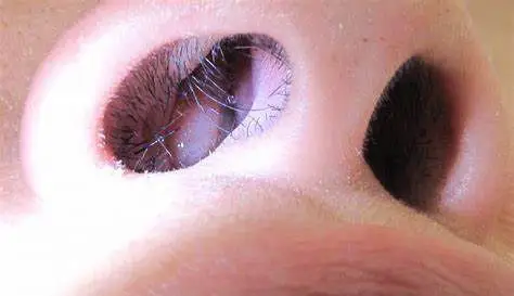 鼻腔里面为什么会长息肉?