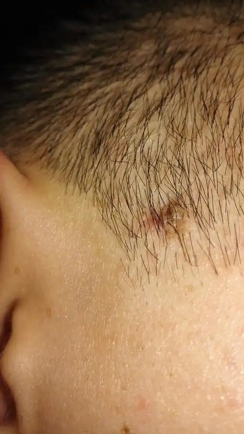 剪好头发,发现头发下面,头皮上长了个包,不疼也不痒,请问医生,是什么