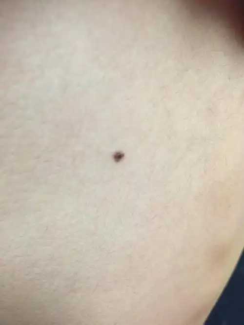 宝宝背上有颗痣,不知道这个痣危险不,看着挺大的,想激光去掉又怕宝