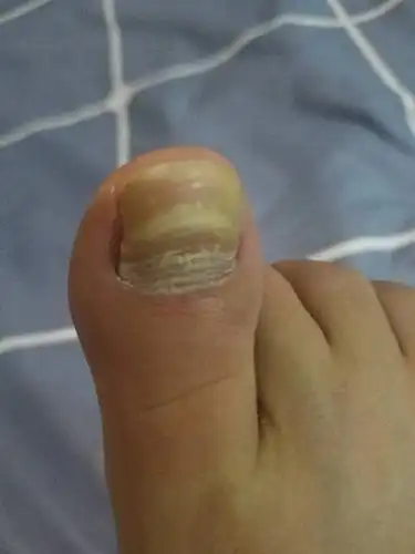 我脚趾甲怎么了?一层一层的,就像想不出来.顶的变形了