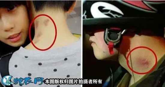 直白的说就是吻痕!男女双方在激情时,在脖子