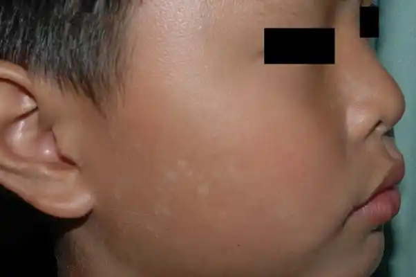 单纯糠疹 (16)_有来医生