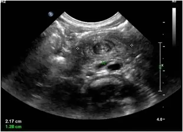 超声诊断先天性肠旋转不良