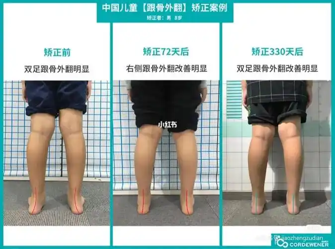 跟骨外翻矫正效果