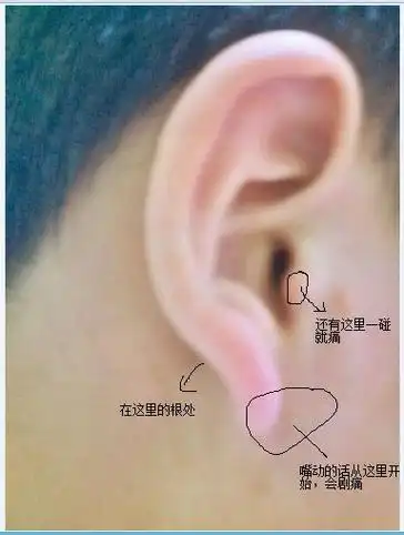 耳屏红肿,耳朵里嗡嗡响,且痛