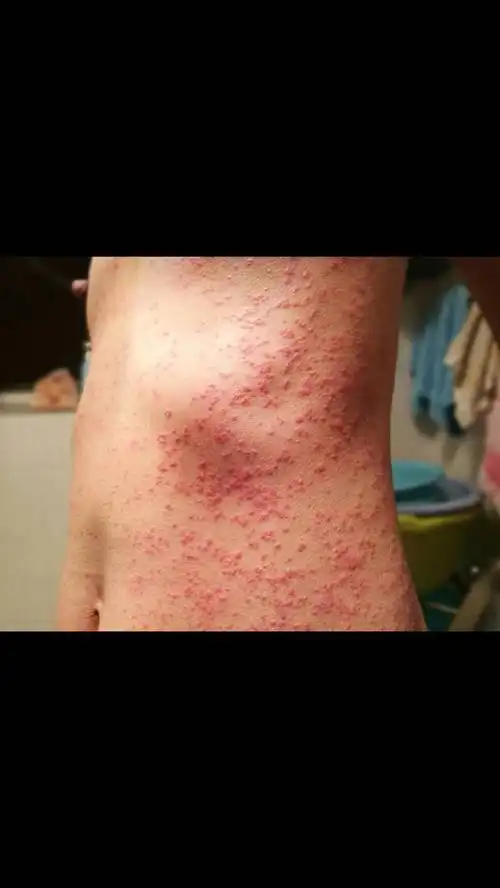 女,35岁,突然就这样腰上起很多红疙瘩,到医院说是过敏,可是息斯敏