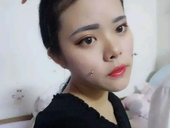 酒窝钉摘掉后图片,打酒窝钉的风险有哪些?