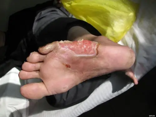 【讨论】左足烫伤后创面感染加深,第v跖骨部分暴露. [病例帖]