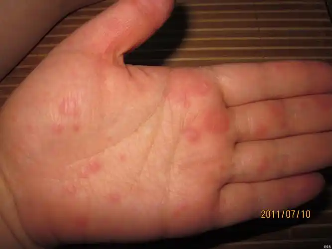 身上多发部位红斑,痒痛,帮忙看看,谢谢!