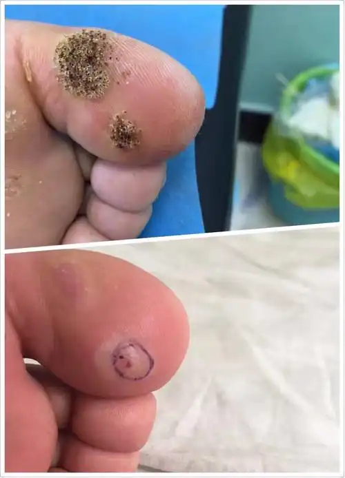 多发性跖疣火针治疗效果