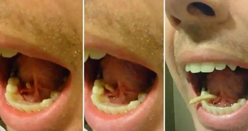 美男总觉得舌下肿胀,没想到舌头用力一推竟挤出近4公分的唾腺结石!