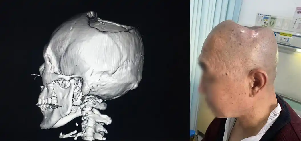 航空总医院穆苍山主任用3d打印peek材料精准修复颅骨,整形外貌