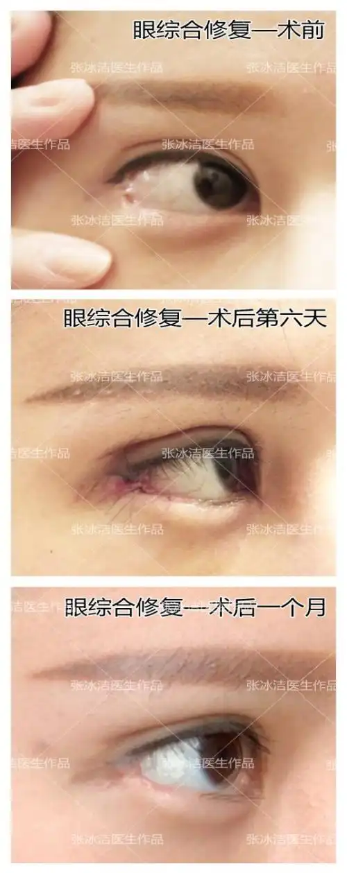 fox改良法作为基础,根据这种情况来解决眼部缺失的皮肤或者睫毛,同时