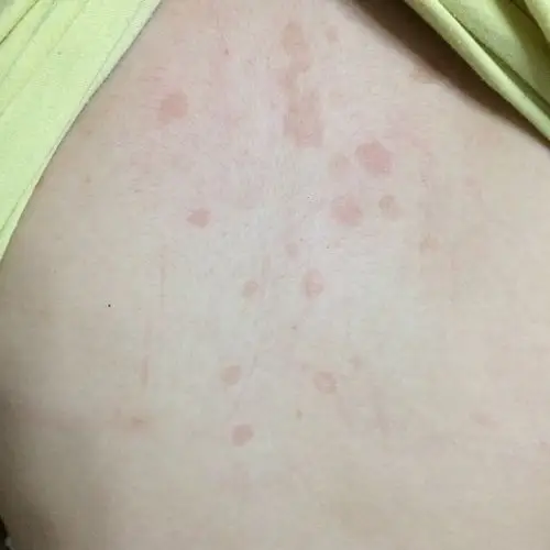 我有更好的答案 2条回答  平时是不是出汗比较多,可能是汗斑,一种