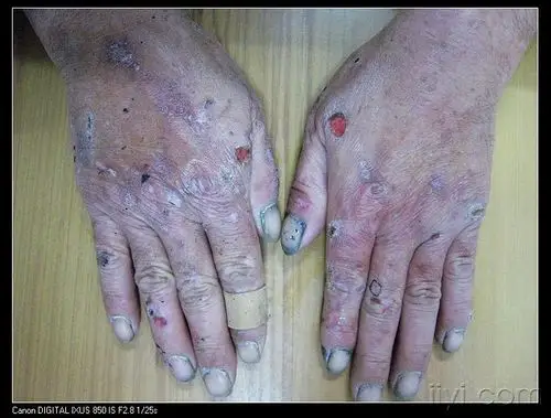 您的诊断迟发型皮肤卟啉症