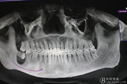大意不得一例埋伏阻生牙囊肿的拔除