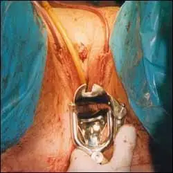 实拍高清图:男变女变形手术全过程 男变女变形手术