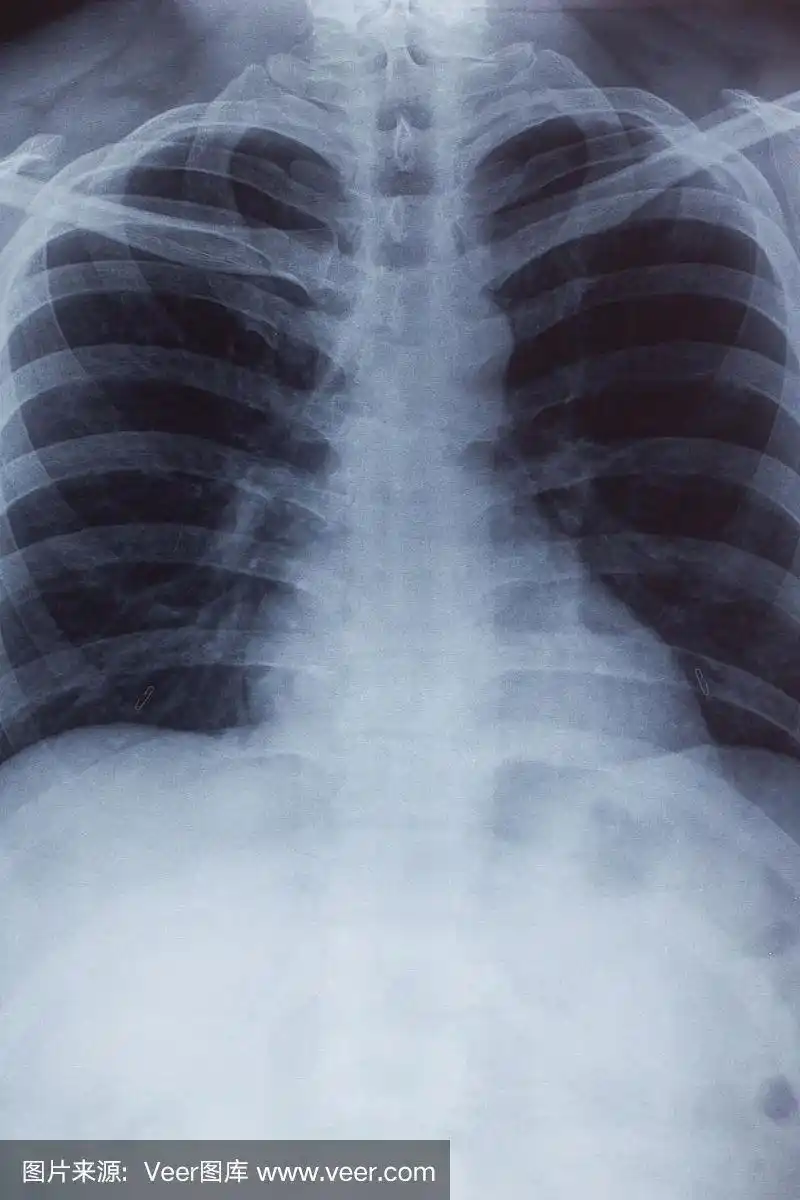 胸部x线照片