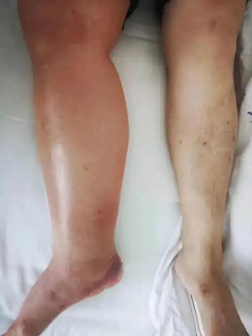 四妙散合五味消毒饮消除肿瘤术后下肢肿胀