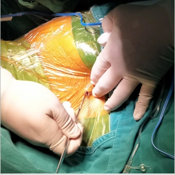 腰大池腹腔分流lps手术实例细节图文版