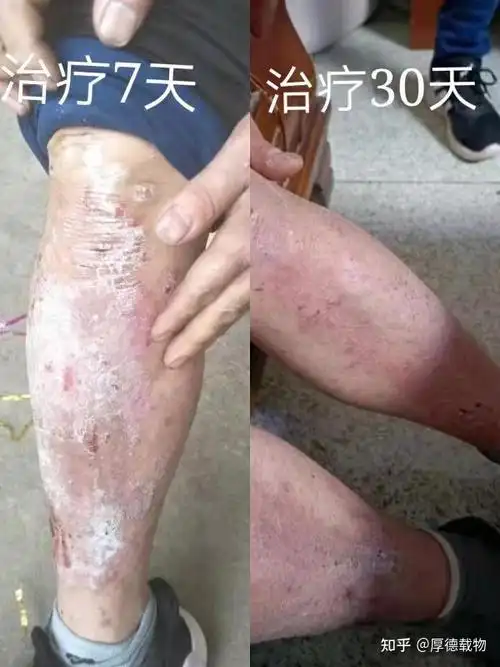 牛皮癣如果长时间不愈合会对身体造成什么伤害?