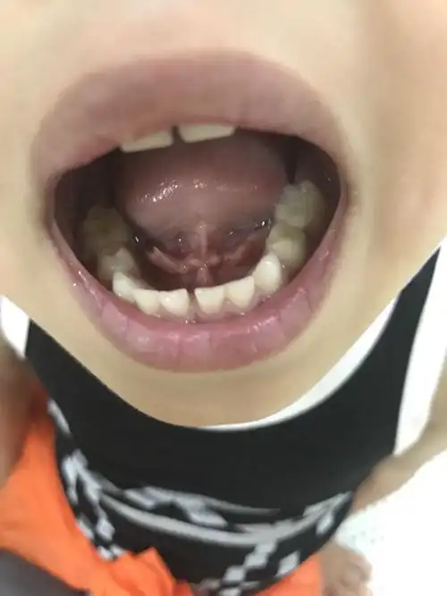 四岁四个月宝宝,外地玩了一周,舌头下突然开始长出带尖的泡,还发烧.