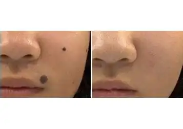 新泰市侨艺去除黑毛痣案例