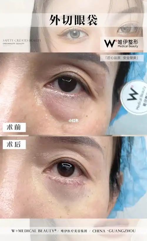 唯伊外切眼袋案例对比