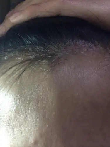 头皮屑很多不知道怎么回事,大概有3,4个