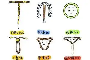 2022t型避孕环的优点及缺点