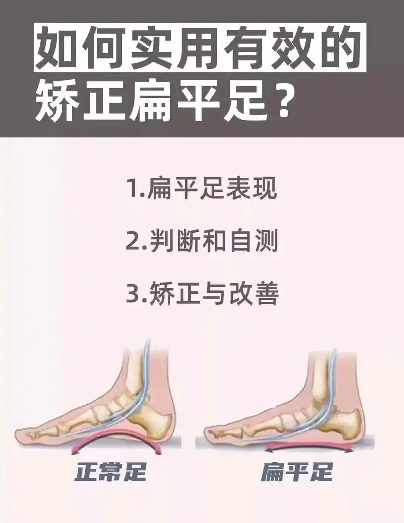 判断扁平足和矫正扁平足#抖音图文来了 #矫正腿型 #足外翻矫 - 抖音