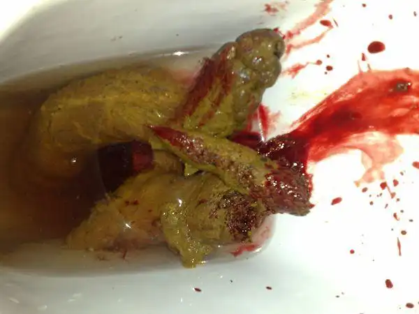 高二学生 最近经常放屁 而且特别多 大便过后有血 颜色鲜红