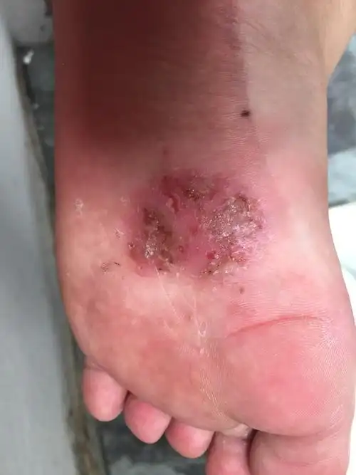 怀孕有脚气怎么办 ?