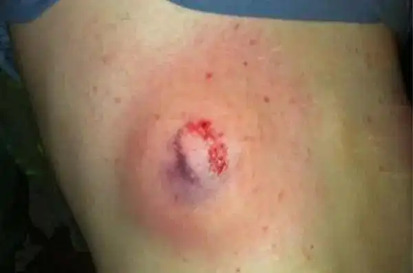 国外警察用的橡胶子弹虽不会造成致命伤害伤口却是触目惊心