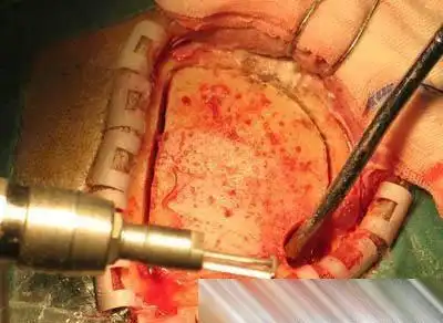 实拍神秘的开颅手术全过程