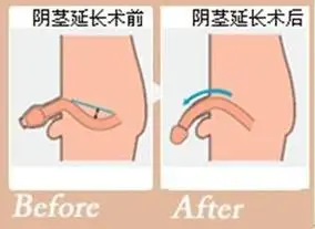 韩式阴茎延长增粗术是在现代微创技术的指导下,利用微创手术