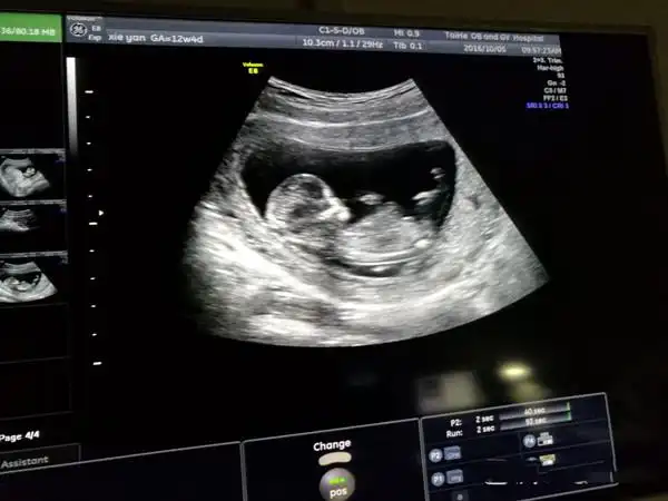 有人说nt检查看生男生女很准的,说是怀孕12周做nt检查已经看到小丁丁