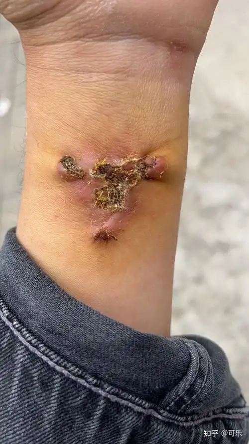 纹身切除手术 - 知乎