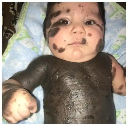 综合外媒9月16日消息,他的胎记表明,他的身体正在努力产生黑色素,并有