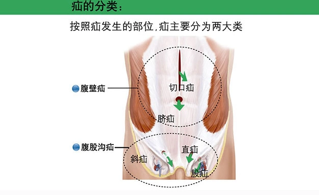 腹股沟疝图片 (11)_有来医生