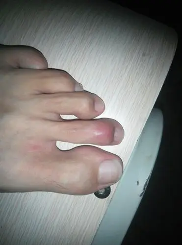 暑假游泳时,把脚趾头弄成锤状趾!之前不是很在意,到现在泪奔啊!