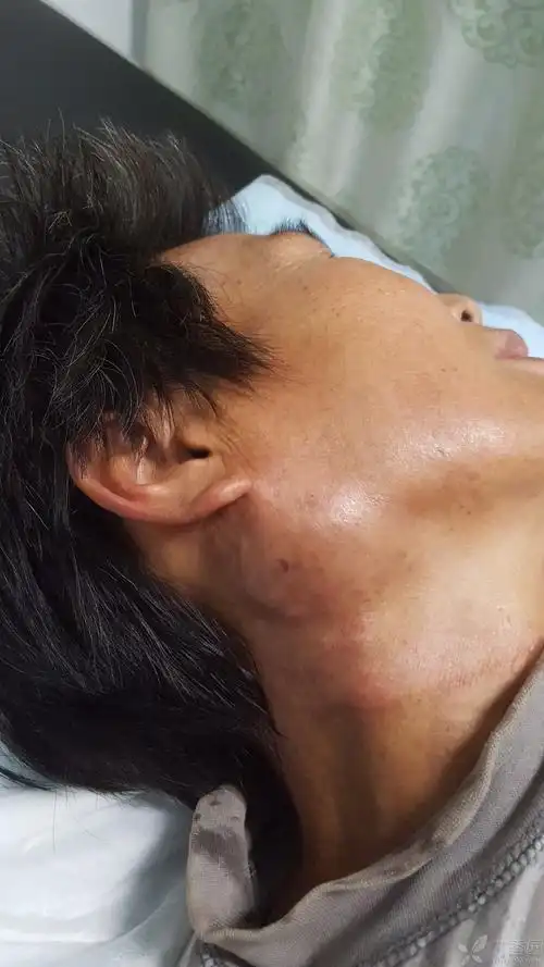 患者性别:女 患者年龄:62 简要病史:发现双侧腮腺无痛性肿大5个月.