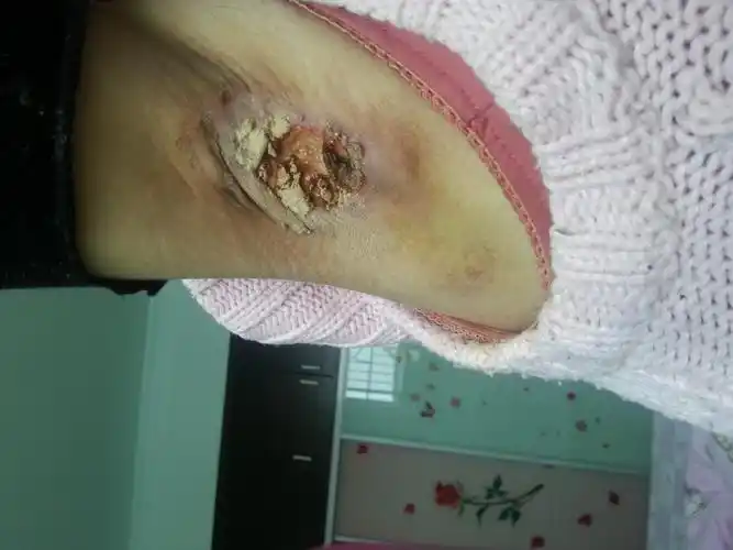 做完腋臭手术十五天了好像坏死了怎么办