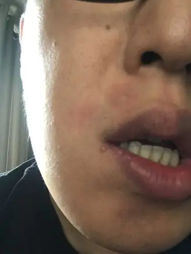 嘴角长了颗痘痘,不痛不痒,请懂得帮我看下好吗?谢谢大家