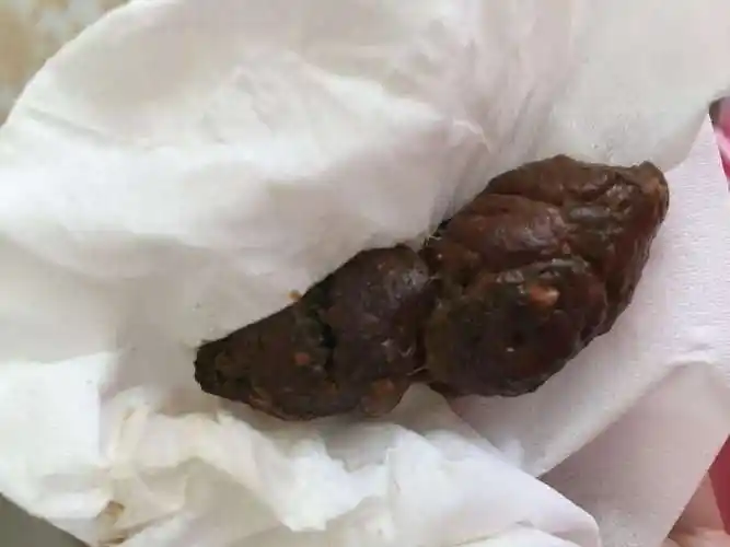 大便太干是什么原因(大便太干是什么原因导致的肠道蠕动力和感知力)