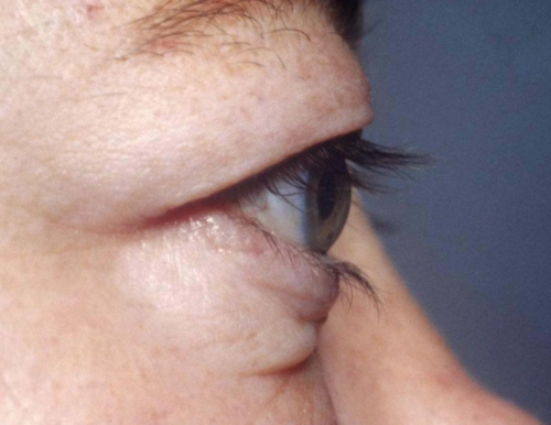 眼球凸出是眼镜的锅么