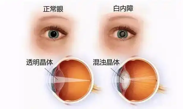 由于近视眼的眼内血液循环障碍及组织变性等异常,让晶状体逐渐发生